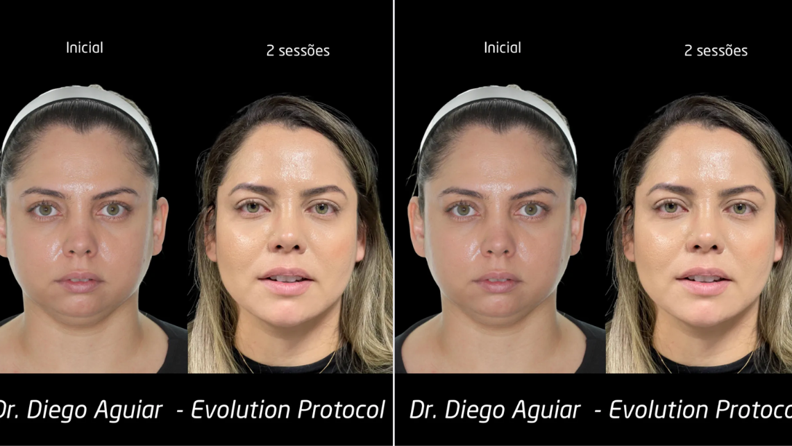 harmonização facial